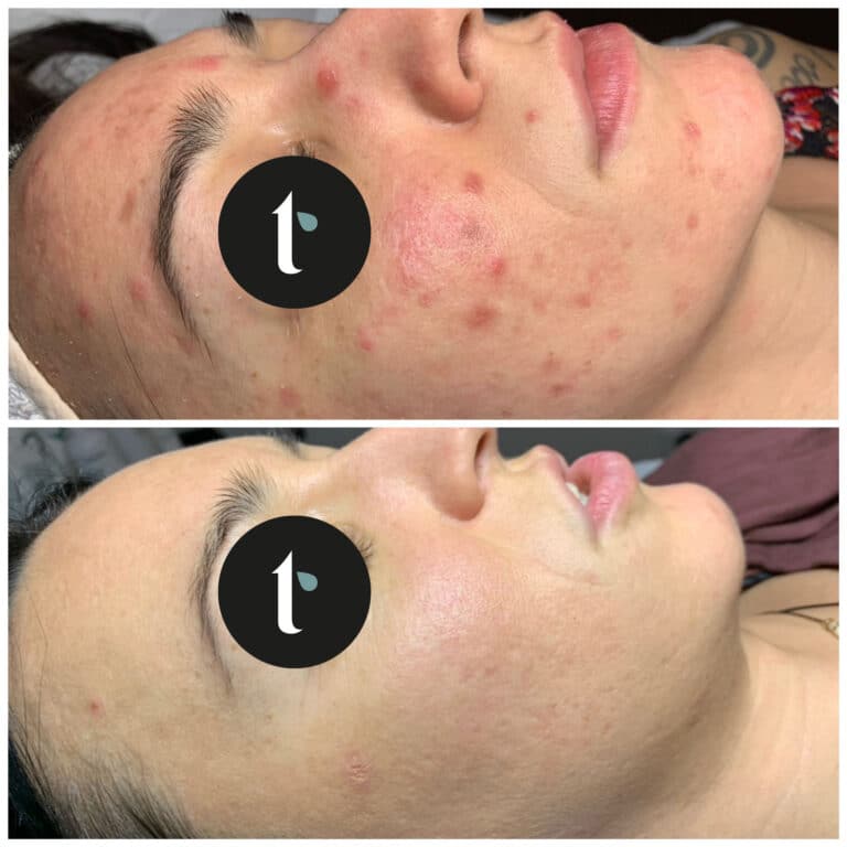 t-shine-skincare-prima-e-dopo-1