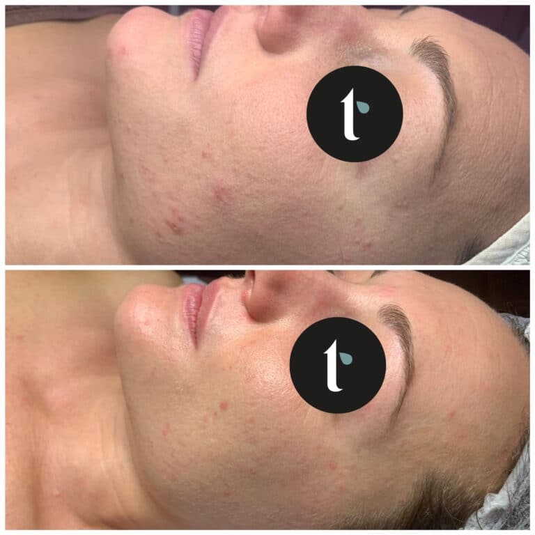 t-shine-skincare-prima-e-dopo-2