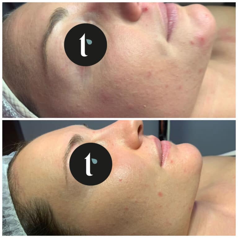 t-shine-skincare-prima-e-dopo-3