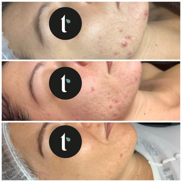 t-shine-skincare-prima-e-dopo-4