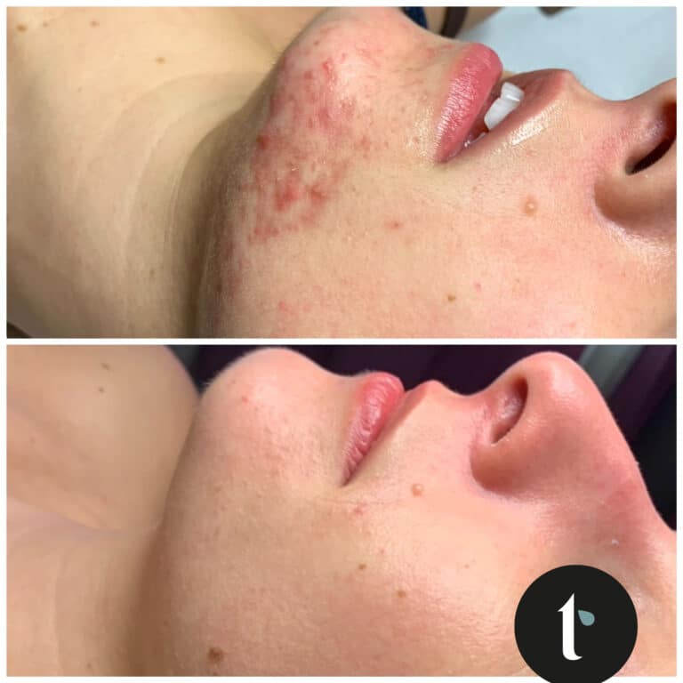 t-shine-skincare-prima-e-dopo-5