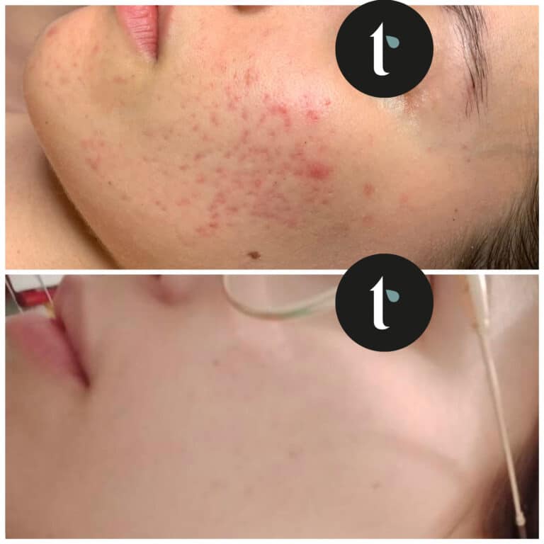 t-shine-skincare-prima-e-dopo-6