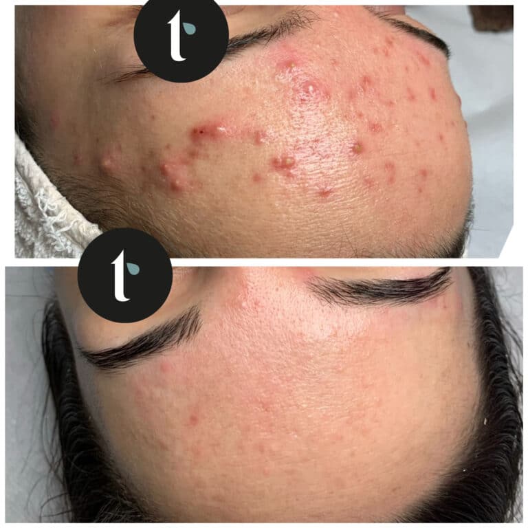 t-shine-skincare-prima-e-dopo-7