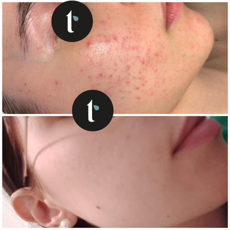 t-shine-skincare-prima-e-dopo-8
